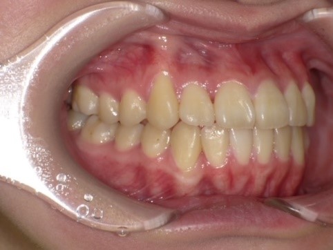 名東区　歯医者　インビザライン症例（叢生）12ヶ月後
