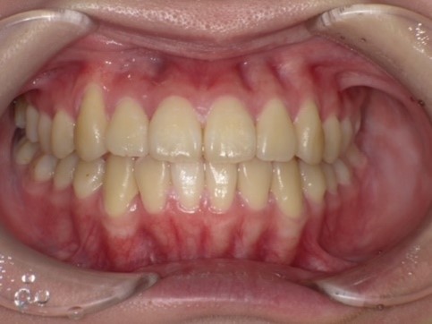 名東区　歯医者　インビザライン症例（叢生）12ヶ月後