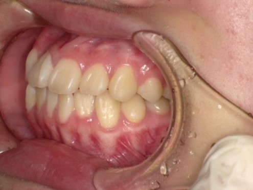 名東区　歯医者　インビザライン症例（叢生）初診