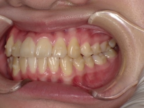 名東区　歯医者　インビザライン症例（叢生）5ヶ月後