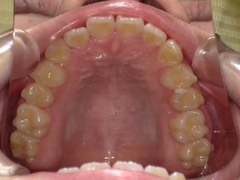 名東区　歯医者　インビザライン症例（叢生）5ヶ月後