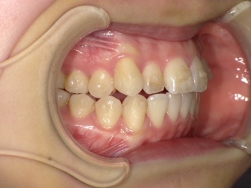 名東区　インビザライン症例（叢生）12ヶ月後　西山歯科