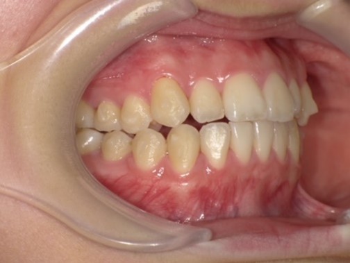 名東区　インビザライン症例（叢生）17ヶ月後　西山歯科