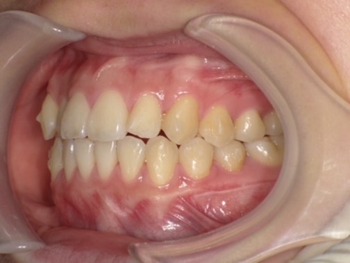 名東区　インビザライン症例（叢生）17ヶ月後　西山歯科