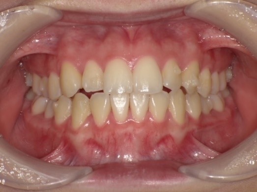 名東区　インビザライン症例（叢生）24ヶ月後　西山歯科