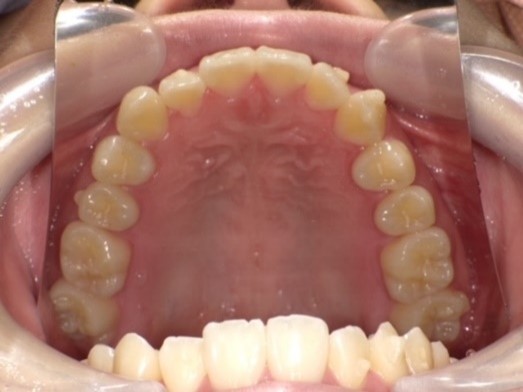 名東区　インビザライン症例（叢生）24ヶ月後　西山歯科