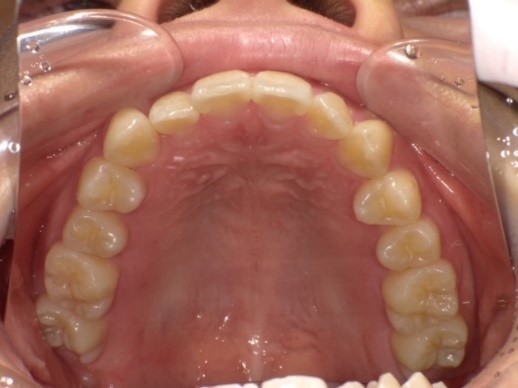名東区　インビザライン症例（叢生）29ヶ月後　西山歯科