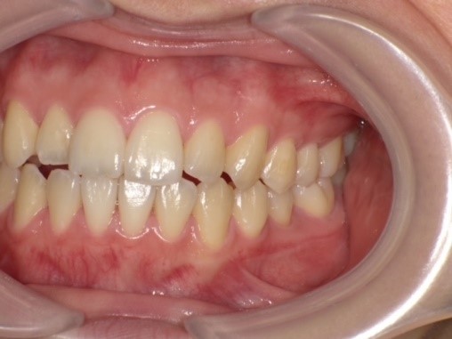 名東区　インビザライン症例（叢生）35ヶ月後　西山歯科