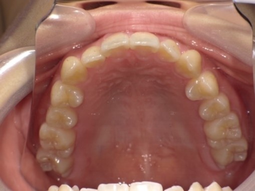 名東区　インビザライン症例（叢生）35ヶ月後　西山歯科