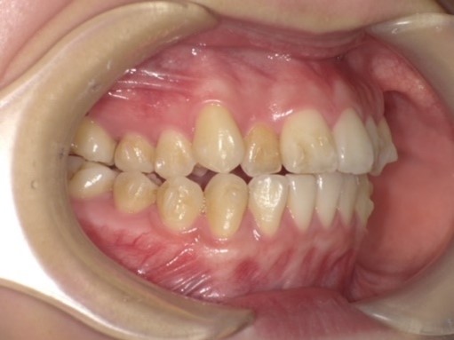 名東区　インビザライン症例（叢生）5ヶ月後　西山歯科