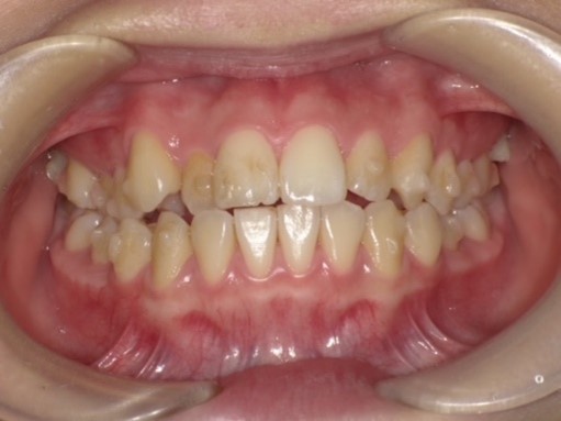 名東区　インビザライン症例（叢生）5ヶ月後　西山歯科