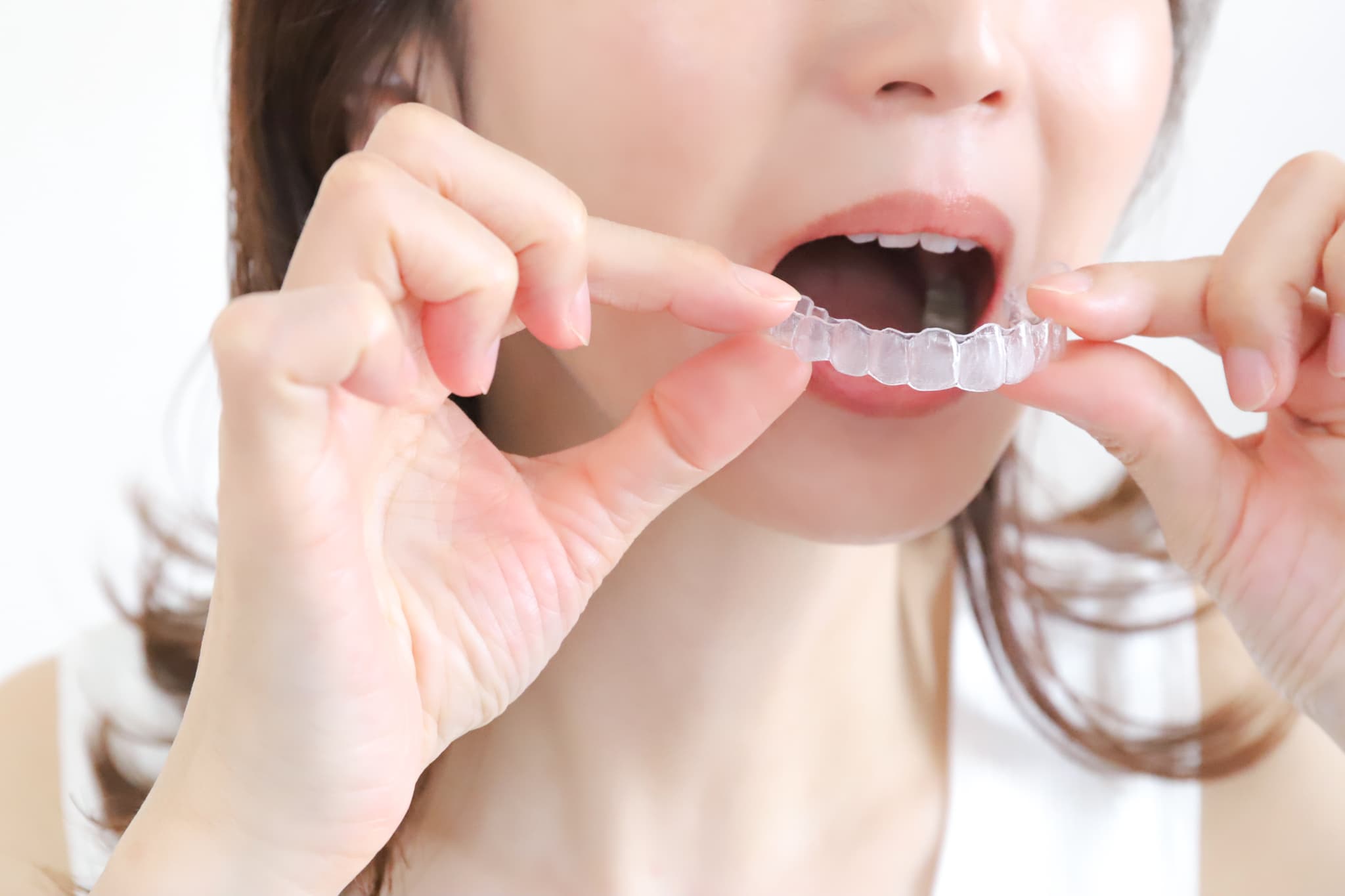 抜歯をせずにマウスピース矯正を開始した女性