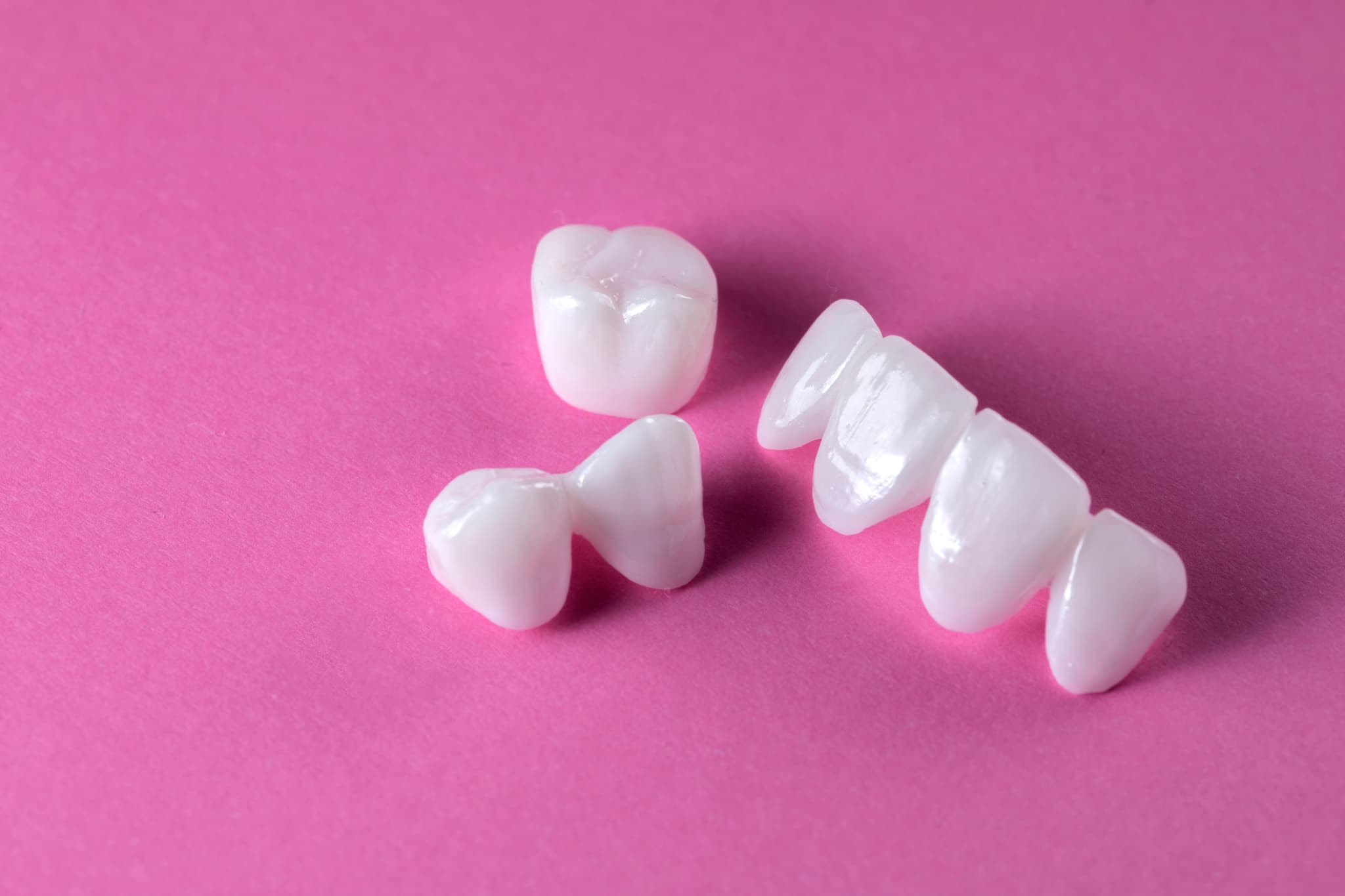 銀歯を白くする治療の種類イメージ