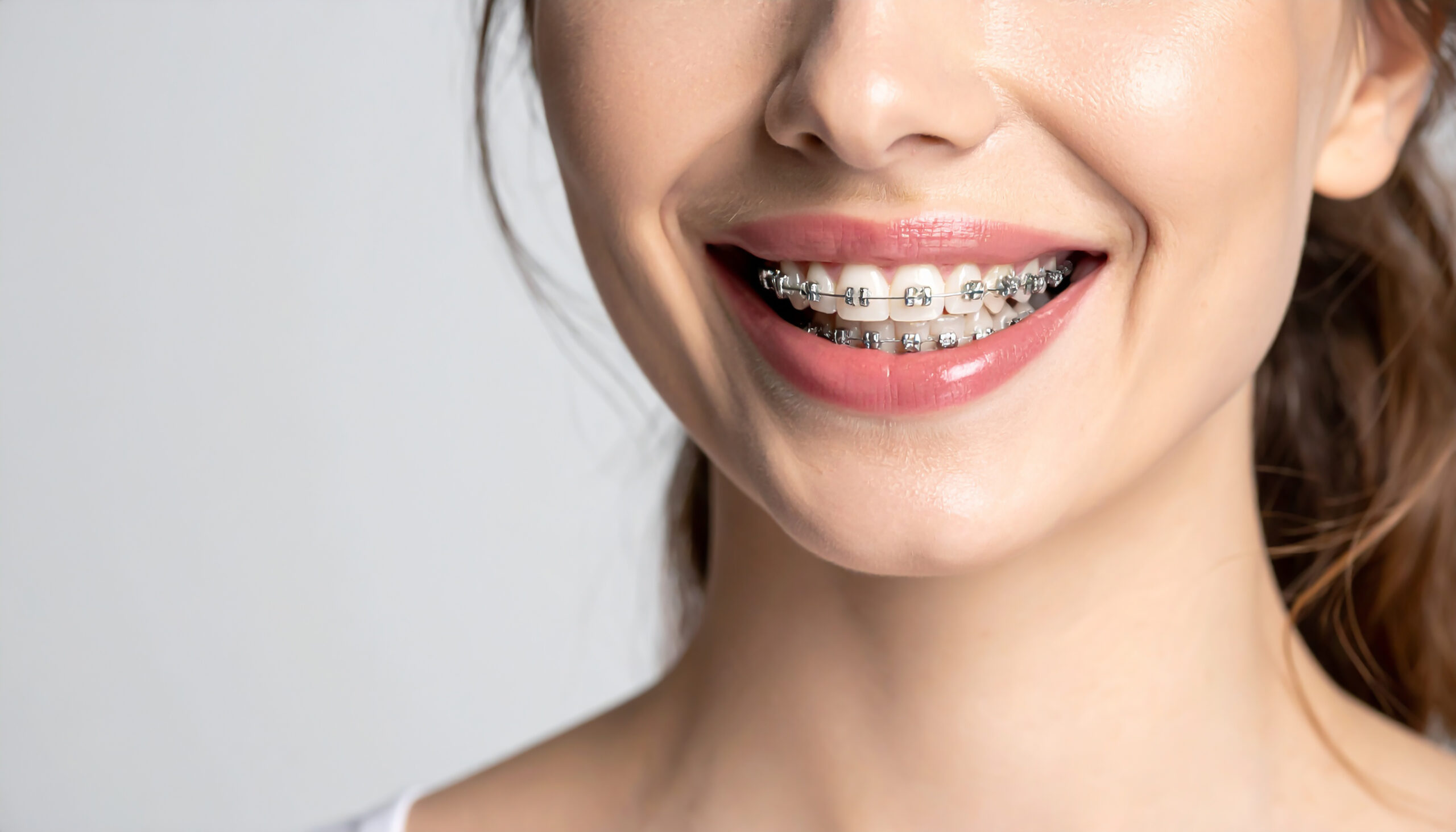 出っ歯を矯正中で歯並びが綺麗になってきている女性