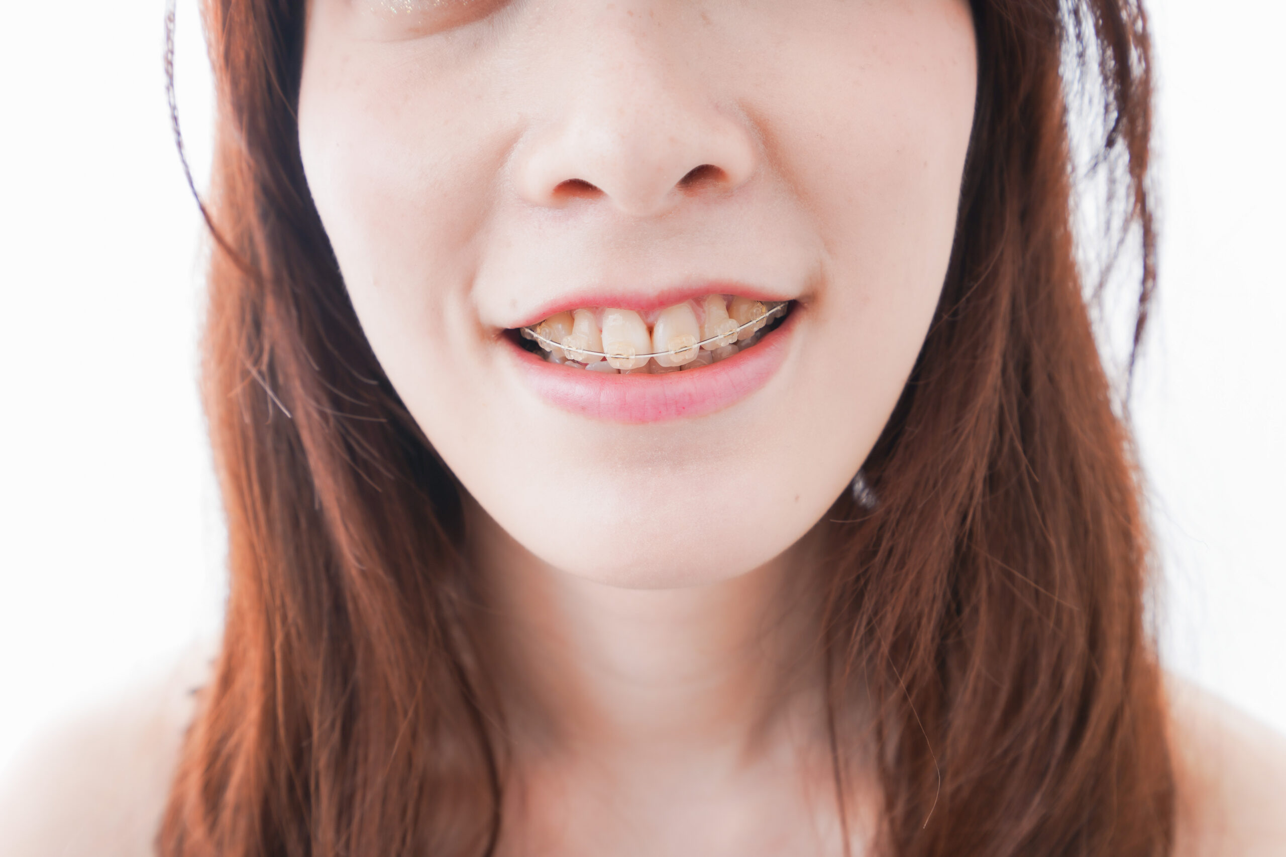 出っ歯を矯正している女性