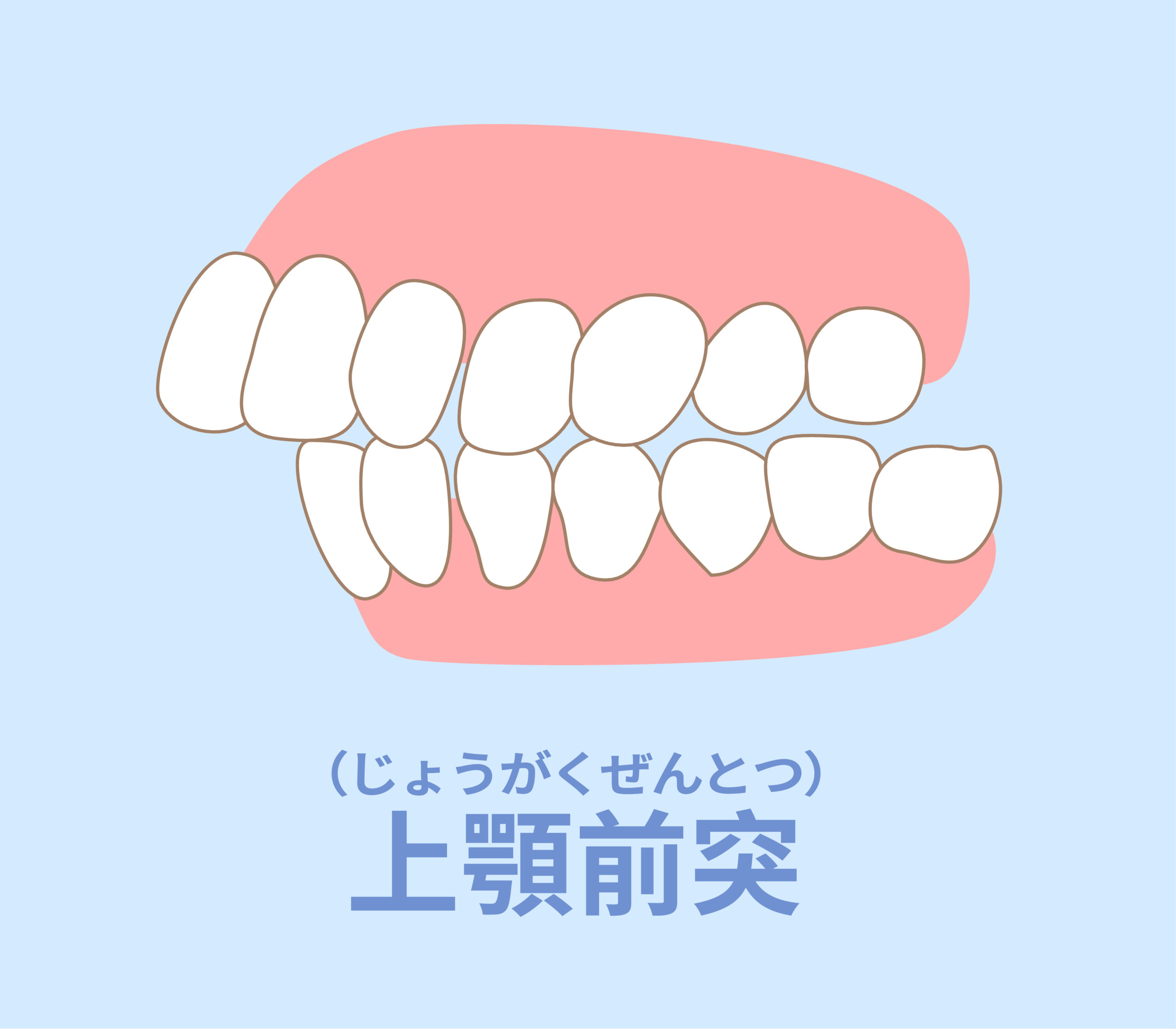 出っ歯（上顎前突）のイメージ