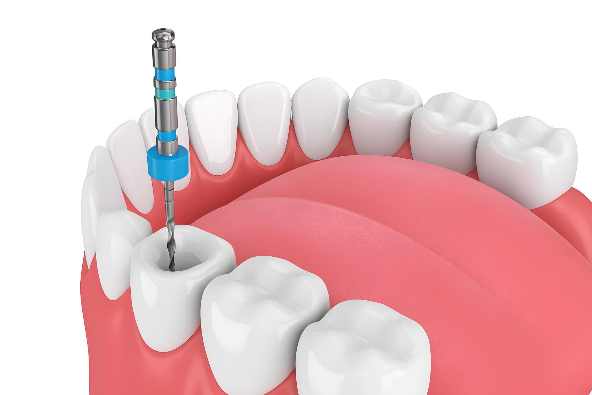 根管治療のイメージ