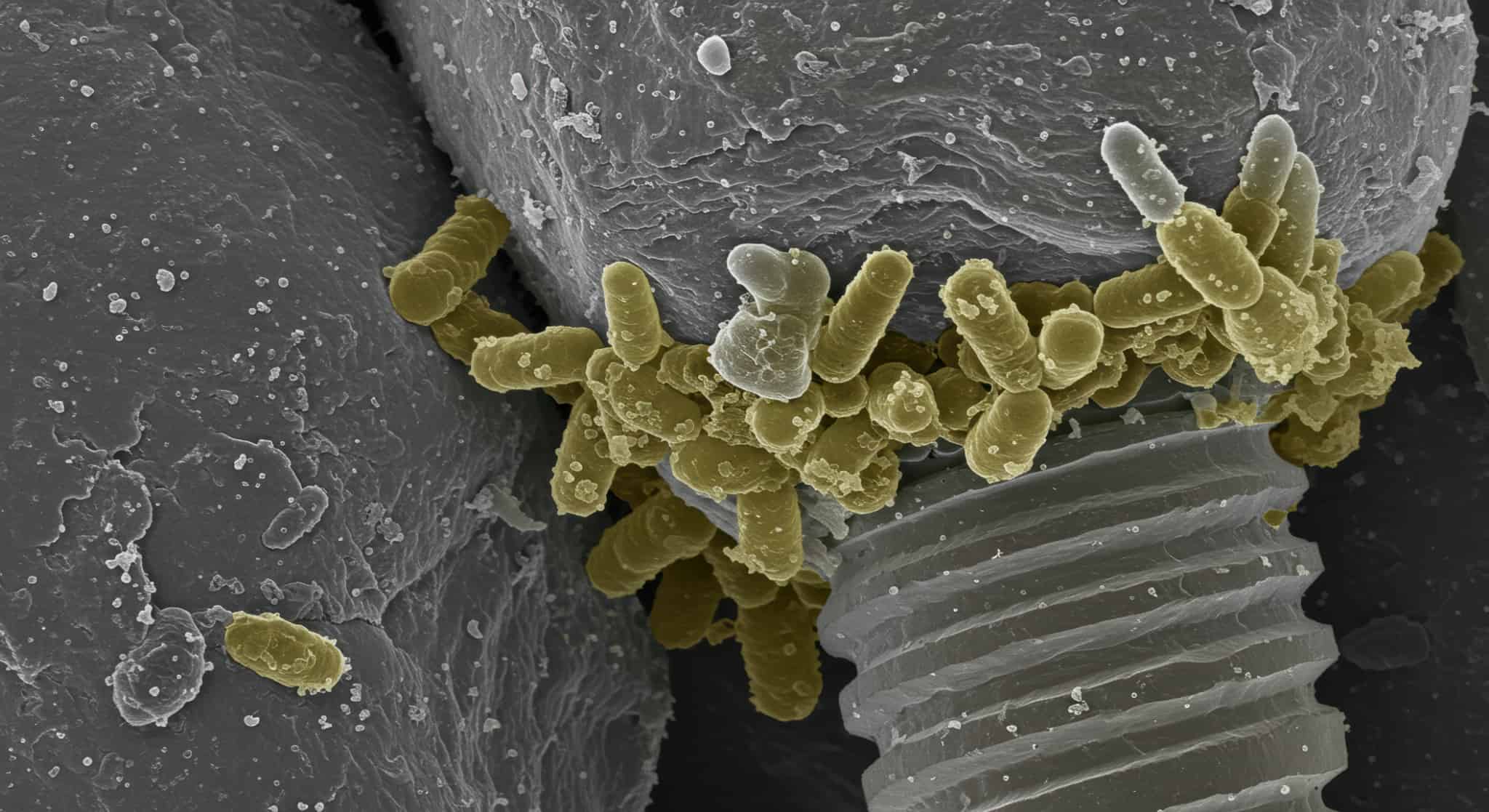 インプラントを埋めた歯茎周辺に細菌が増殖しているイメージ