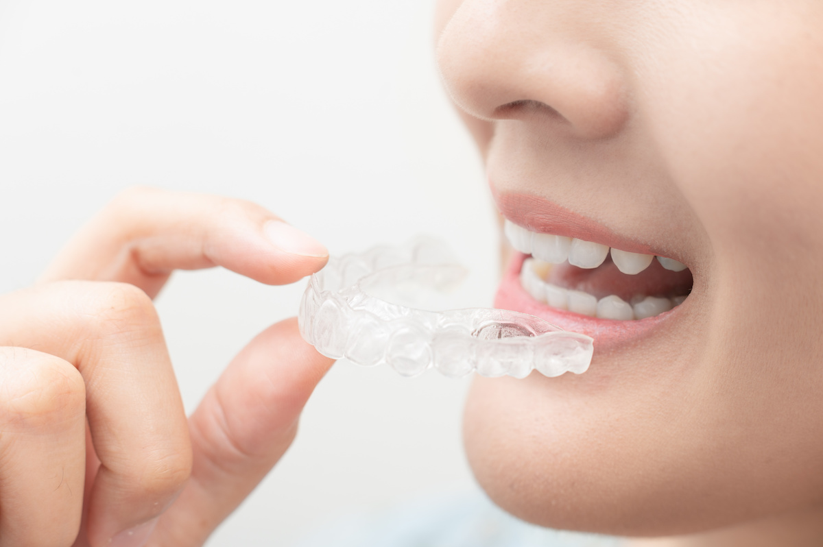 マウスピース矯正をする女性