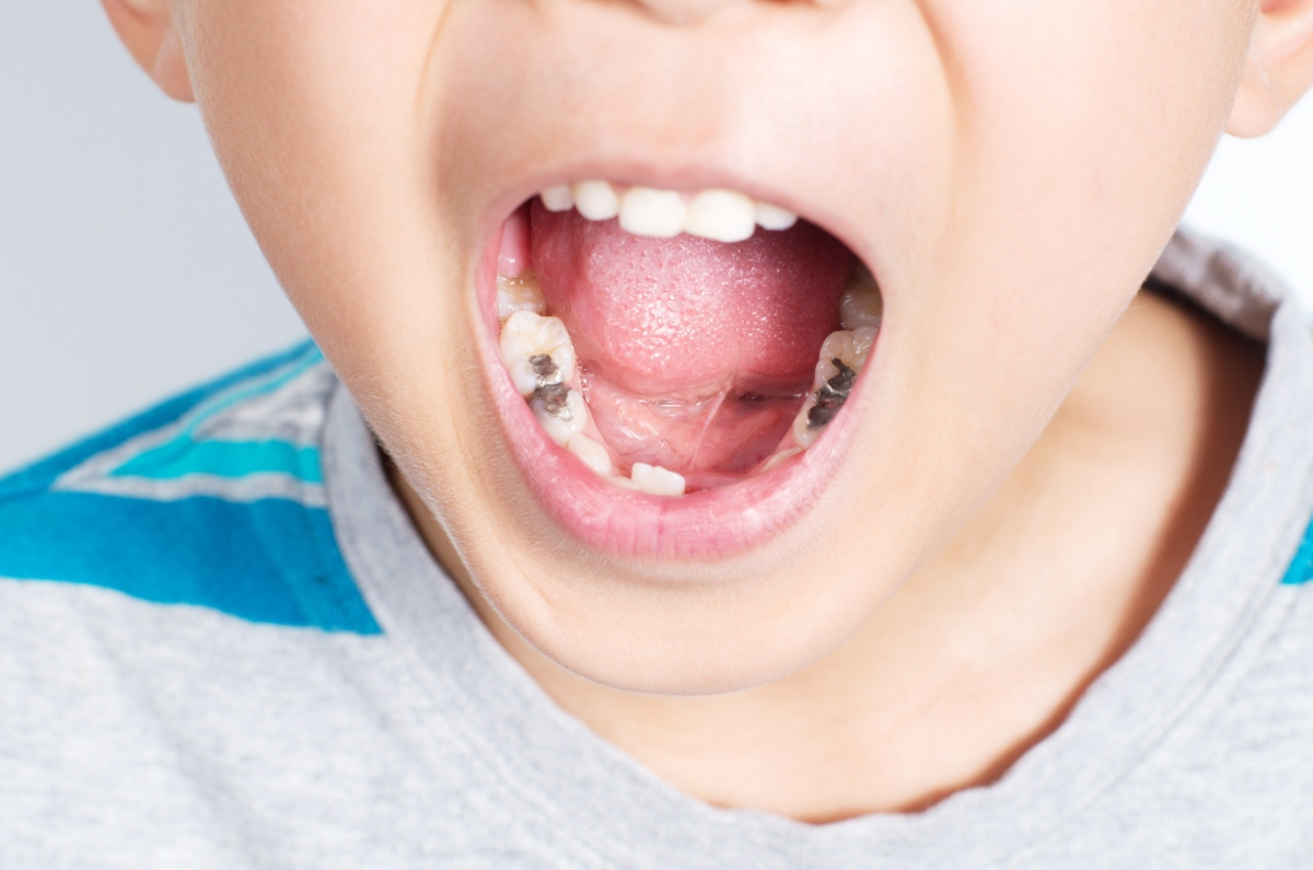 子どもの歯が虫歯になっている様子