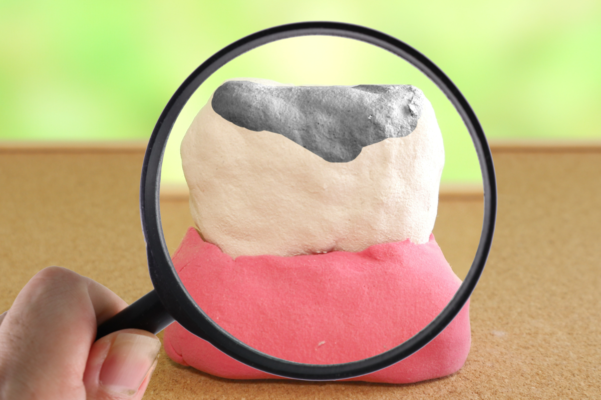 歯の被せ物の種類と特徴！自分に合った素材を見つけよう