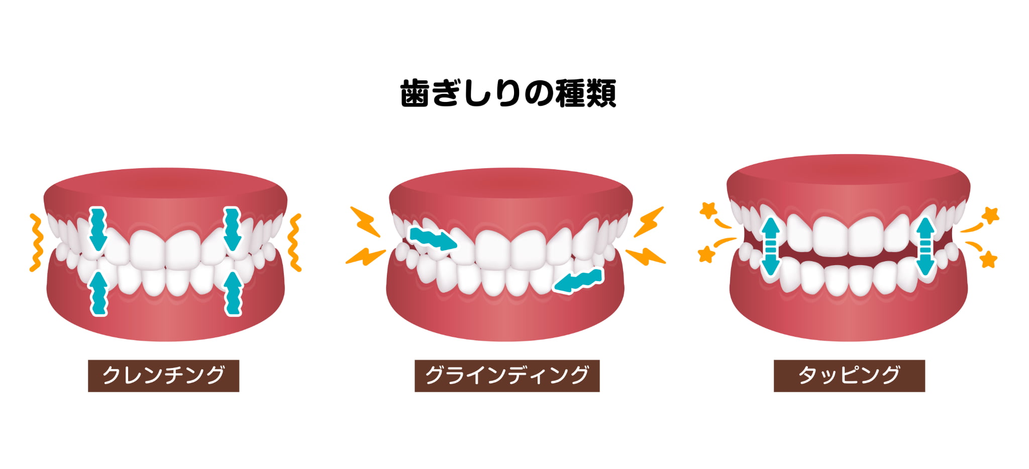 歯ぎしりの種類の図解